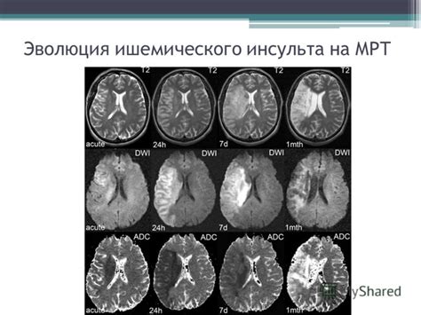 Презентация на тему: "Тяжелый ишемический и геморрагический инсульт ...