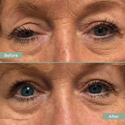 Before After Photos | Eyes, Lids & Face Clinic | Our Work