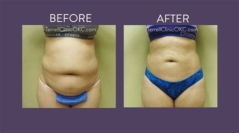 Upper-and-Lower-Abdomen-8 - Terrell Clinic