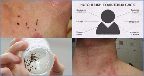 В каких случаях блохи кусают людей и как выглядит укус на человеке?
