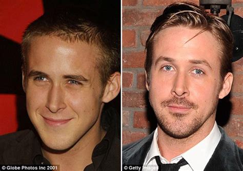 How much plastic surgery did Ryan Gosling have on his face?