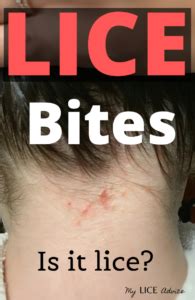 identify  lice advice