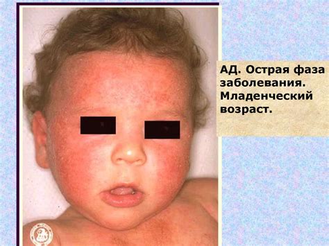 Атопический дерматит - презентация онлайн