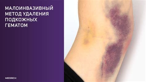 Малоинвазивный метод удаления подкожных гематом