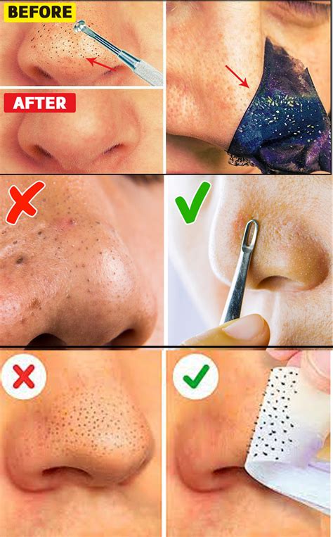 Remove acne marks 3 step natural remedies for pimple marks _ prachi ...