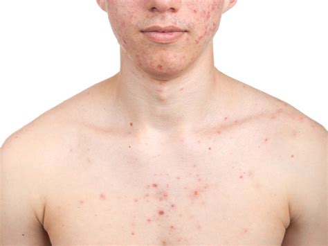 Chest Acne Treatment | Palo Alto, CA | From Europe with Love