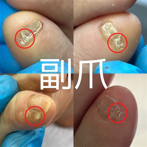 お客様のお手入れのご紹介☆副爪って何？ | 堺市 なかもず／ドイツ式フットケアサロン REFLERIA(リフレリア)