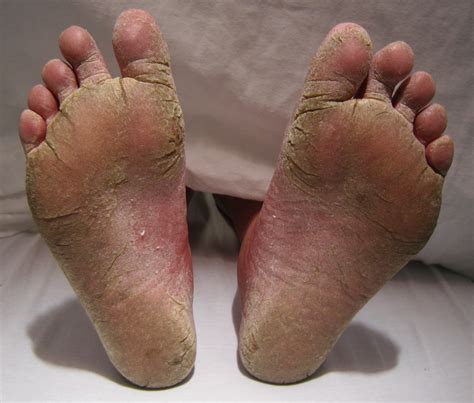 microbial diseases   skin boundless microbiology study guides