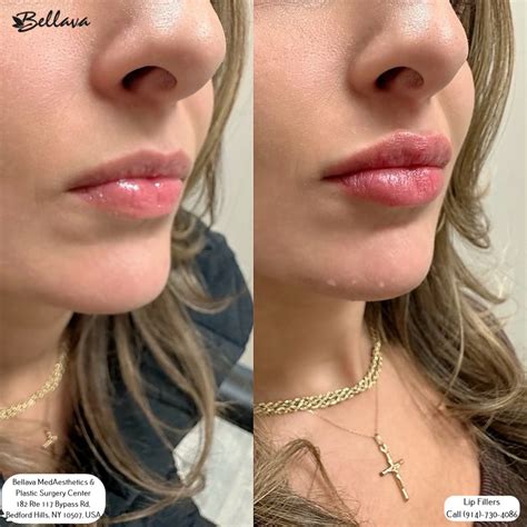 O.5 Ml Lip Filler Lip Filler Before & After Results Skinly
