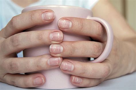 Чому на нігтях з’являються білі плями - Health 24
