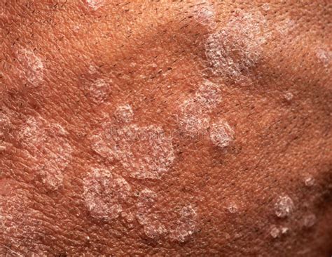 Ringworm Scalp Stock Photos - Free & Royalty-Free Stock Photos from ...