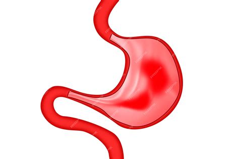 Gastroduodenitis inflamación de las membranas mucosas del estómago y el ...