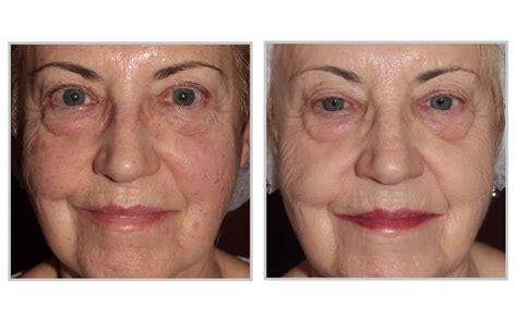 Forever Young BBL Laser Sydney | Infinity Skin Clinic