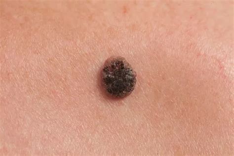 cancer warning signs      face daily record
