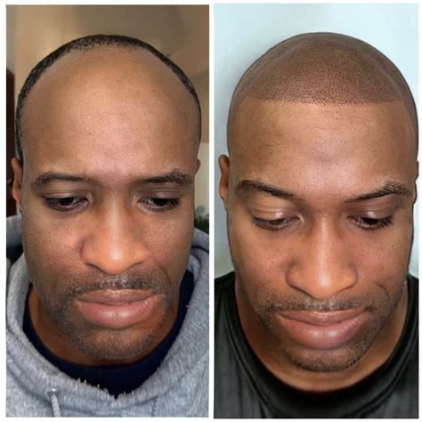 Scalp Micropigmentation | Defy Your Hair loss With (SMP)