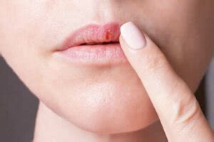 De kenmerken van het herpes-simplexvirus - Gezonder Leven