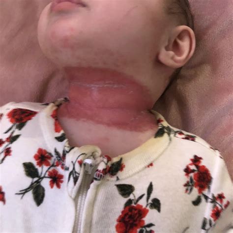 Yeast Skin Rash How To Cure Fungal Infection On Skin Naturally At Home