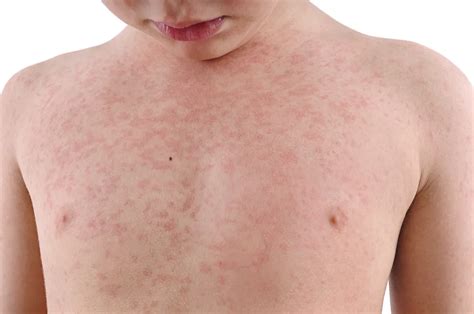 The Most Common Skin Rashes In Children – ActiveBeat – Your Daily Dose ...