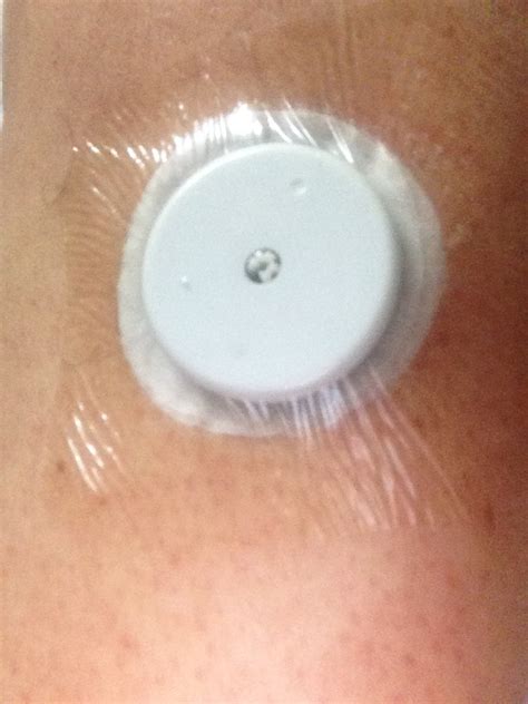 Freestyle Libre Sensor Allergic Reaction - Sensor Web Blog