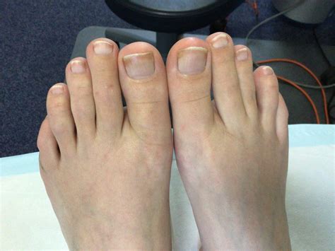 How do I get rid of my fungal nail infection? | ProFeet Podiatry