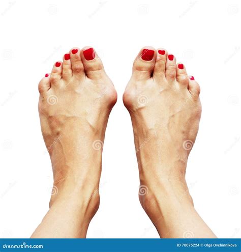 Valgus Deformity of Legs Due of the Cross Flatfoot (hallux Valgus