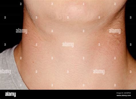 Swollen lymph gland (lymphadenopathy) in the neck in a 15 year old male ...