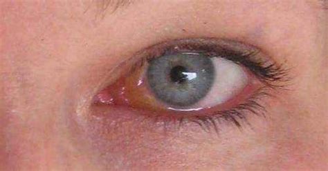 swollen tear duct  symptoms  treatment eyexancom