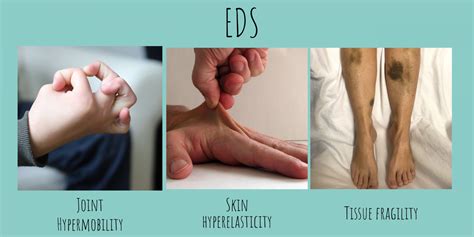 Ehlers-Danlos Syndrome | Orthopedic & Physical Therapy Waco