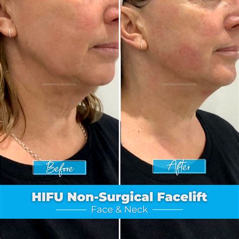 hifu face treatment 9