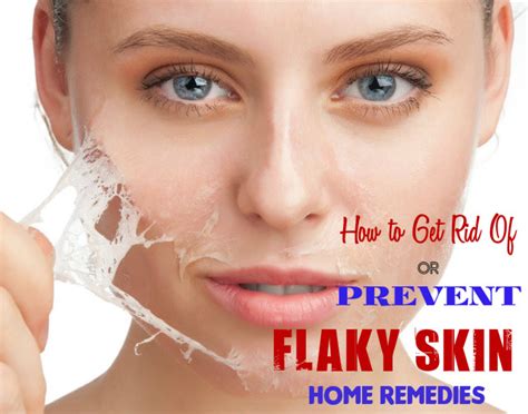 Pimples On Chin Home Remedies: Dry Flaky Skin Home Remedies