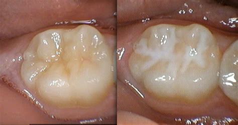 fissure sealants western dental hygiene