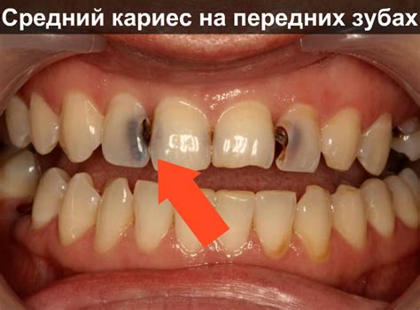 Средний кариес: причины, симптомы, осложнения, лечение, фото | Взубе.ком