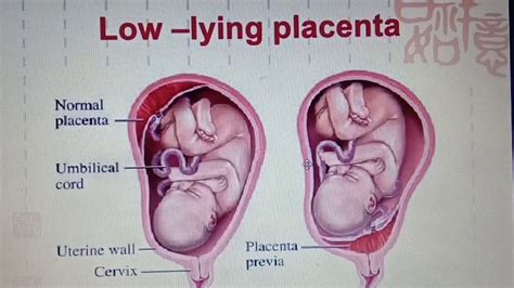 Placenta Previa क्या है, Low Lying Placenta, Placenta Position, Type Of ...