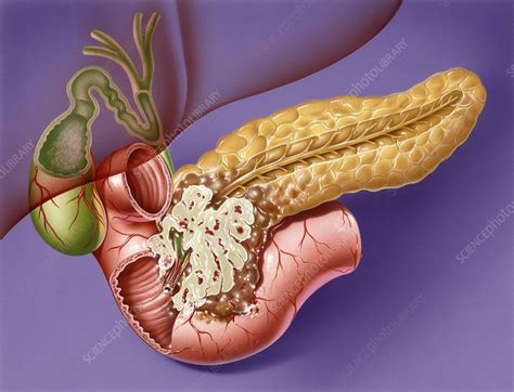 Pancreatic cancer, artwork - Stock Image - M131/0741 - Science Photo ...