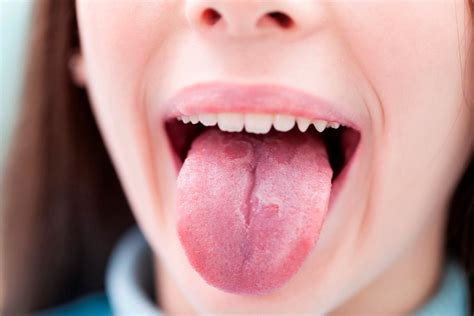 Ampolla Blanca En La Lengua Deals | cdlguaiba.com.br