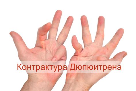 Контрактура Дюпюитрена кисти: причины, симптомы, стадии и лечение