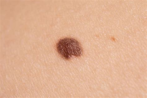 premium photo closeup mole  skin epidermis