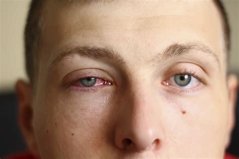 How To Get Rid Of Eye Swelling From Allergic Reaction at Odessa