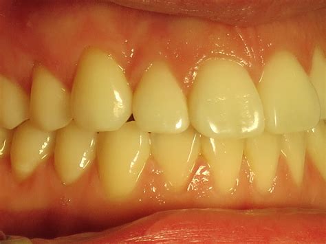 Tooth Resorption Dog Treatment at William Bremner blog