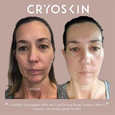 CryoSkin Before and After Photos - Simply Kneaded