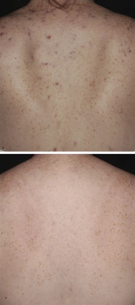 BBL Acne Treatment for Clear, Beautiful Skin | Daydreams Spa