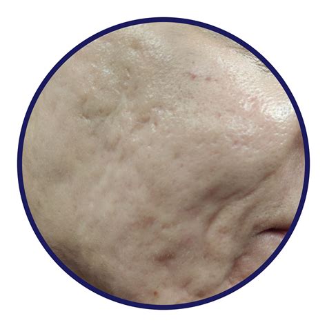 Acne: scopri il nostro ambulatorio specialistico - IDI News