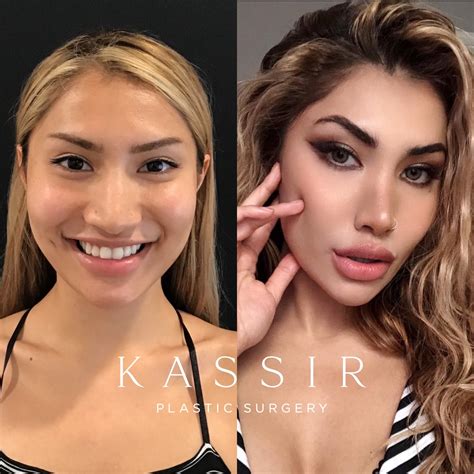Best Rhinoplasty I Designer Rhinoplasty by Dr. Kassir — Kassir Plastic
