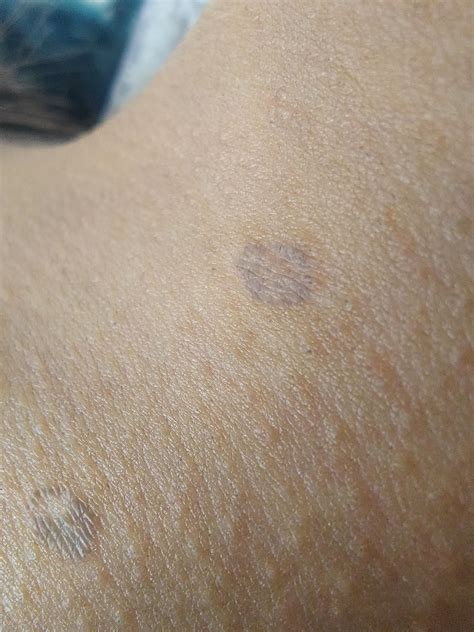 Is this ringworm or psoriasis related? They turn blue because of my