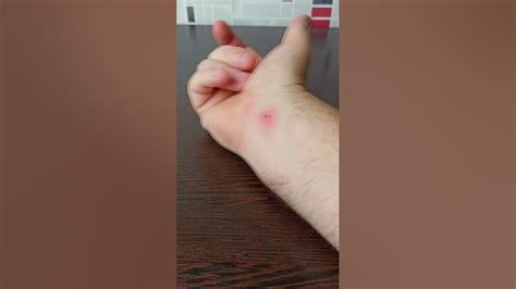 Как избавиться от укуса мадагаскарского таракана. Последствия укуса ...