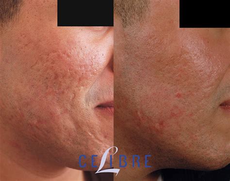 Acne Scar Removal Before and After Pictures of Actual Patients