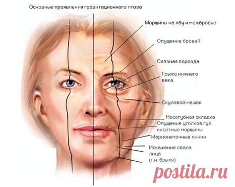 Гравитационный птоз – как меняется лицо и что делать в этом случае ...