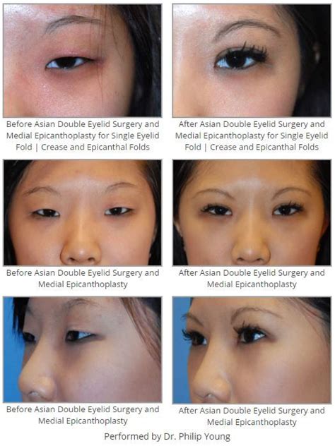 Single Eyelid Vs Double Eyelid