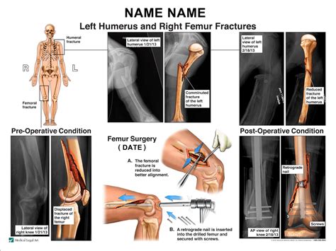 Humerus and Femoral Fractures – Snellustrations