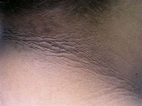 Acanthosis nigricans - Dermatology Advisor